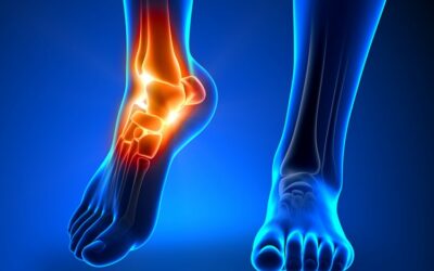 Ankle Instability and Sprains
